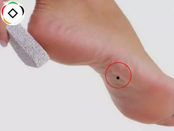 nốt ruồi ở lòng bàn chân